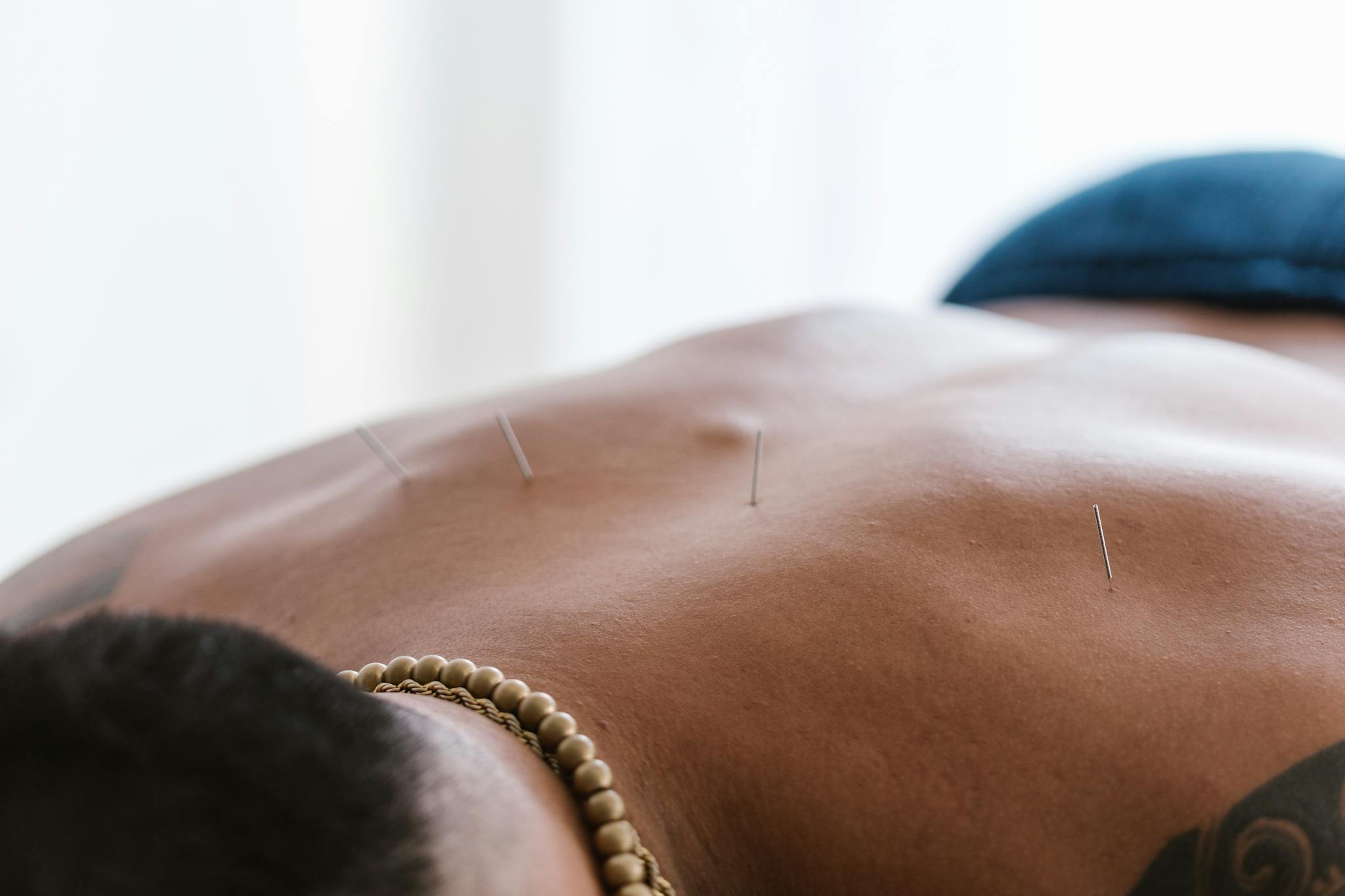 Close-up of acupuncture needles on a person's back during a therapy session in a spa setting.
